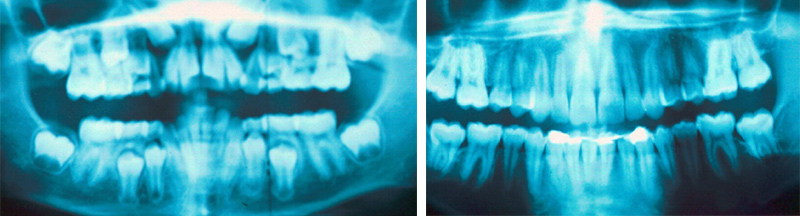 Image-canine-inclusive-maxillaire-Extractions-Selectives