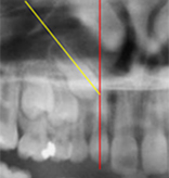 Image-canine-inclusive-maxillaire-Impaction-canine-probable