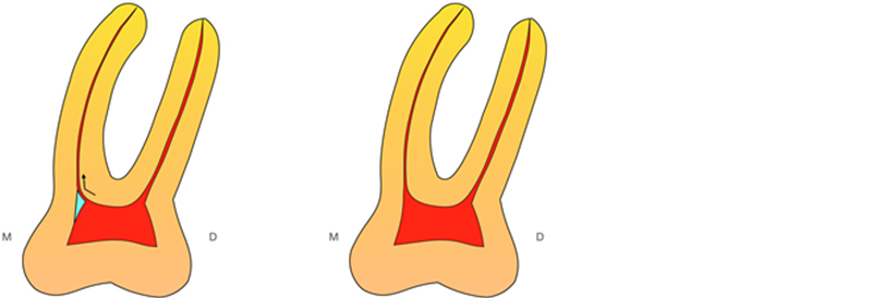 Figure-2-Triangle-Dentinaire-marque-MV2