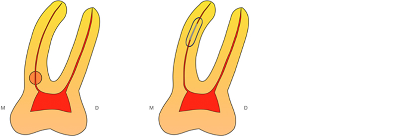 Figure-3-Triangle-Dentinaire-lime-MV2
