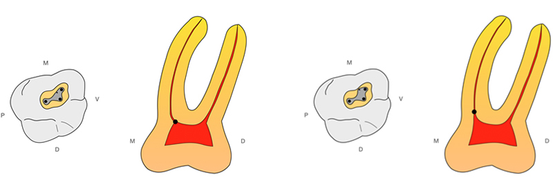 Figure-4-Triangle-Dentinaire-entree-MV2