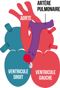 Figure1-article-cardiopathie-congenitale