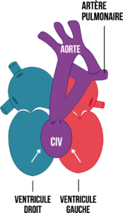 Figure9-article-cardiopathie-congenitale