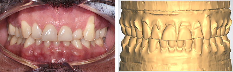Photo-3-Article-Orthodontie-sur-mesure-Ons-Alouini