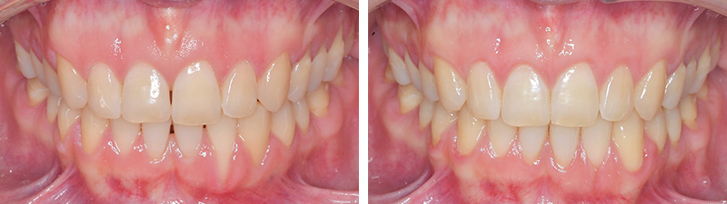 Photo-6-Article-Orthodontie-sur-mesure-Ons-Alouini