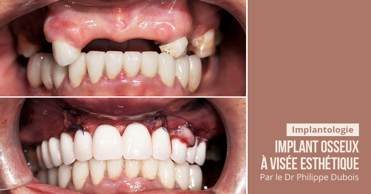 article-eoi-bridge provisoire résine all on 6 sans fausse gencive -  Dentalespace