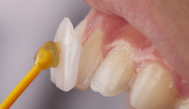 Facettes Dentaires Pelliculaires Paris Dentiste Sourire Clinique Esthetique  - Aiebébé fait ses dents!