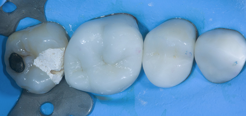 fig-01-dentisterie-adhésive