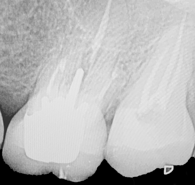 fig-03-dentisterie-adhésive