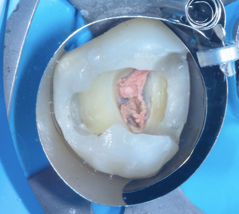 fig-04-dentisterie-adhésive