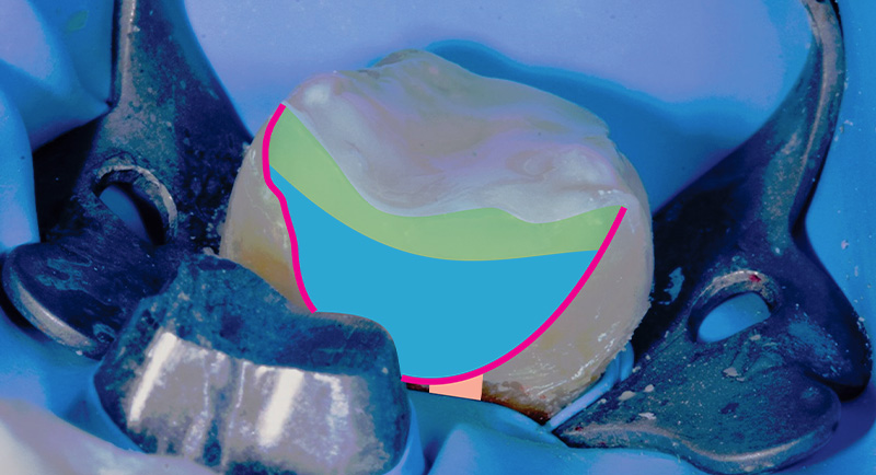fig-06-dentisterie-adhésive