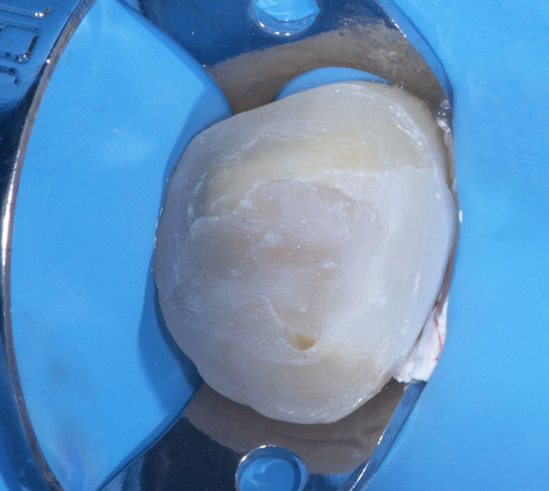 fig-07-dentisterie-adhésive