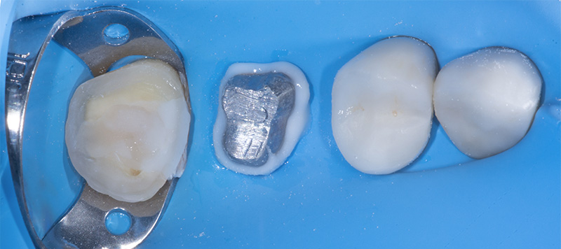 fig-09-dentisterie-adhésive