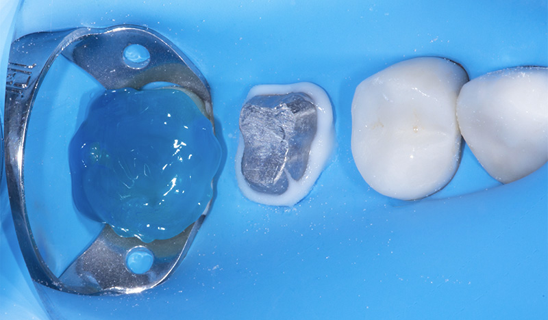 fig-10-dentisterie-adhésive