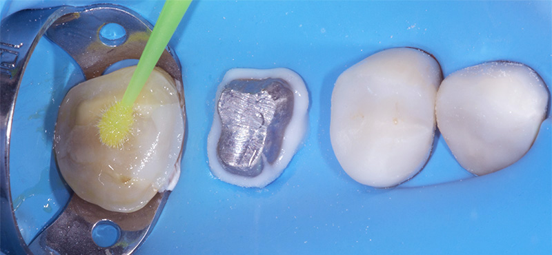 fig-12-dentisterie-Adhésif