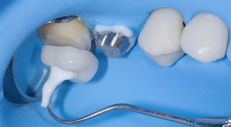 fig-14-dentisterie-Adhésif