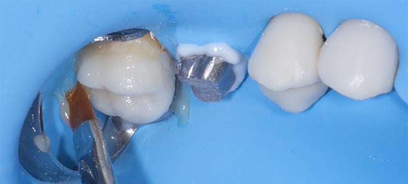 fig-15-dentisterie-adhésif