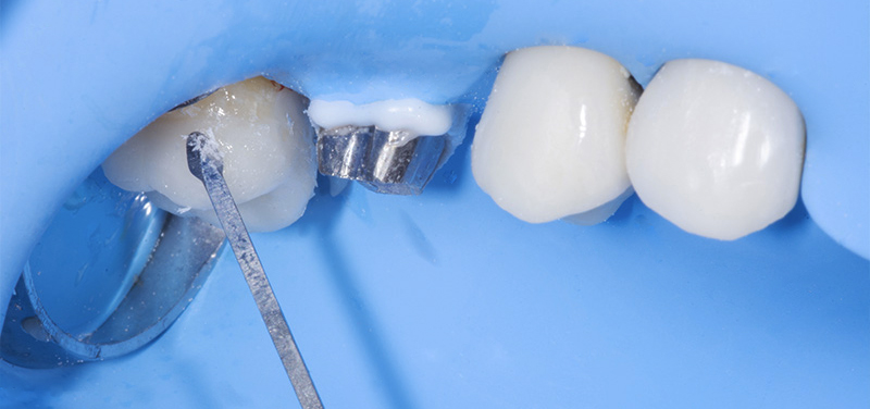 fig-17-dentisterie-adhésif