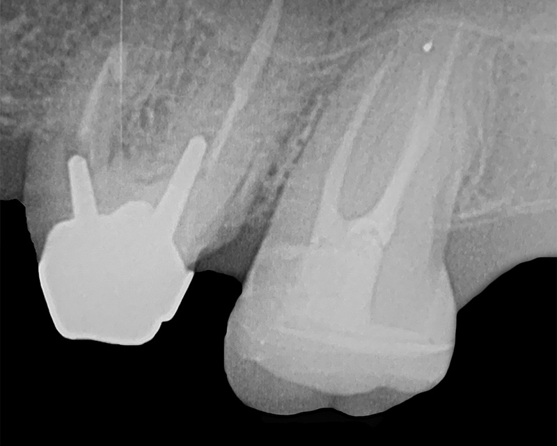 fig-18-dentisterie-adhésif