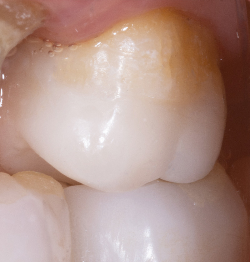 fig-19-dentisterie-adhésif