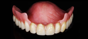 prothèse complète maxillaire-impression 3D