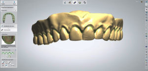 individualisation des dents-impression 3D