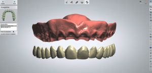 fichiers STL des dents et de la base prothétique-impression 3D