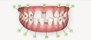 Simulation de traitement orthodontique : visualisez aujourd'hui
