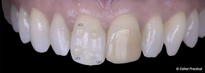 fig03-toledano-composite-stratifié