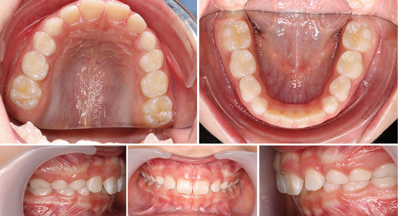 Pansement dentaire : rôle, durée d'utilisation, matériaux