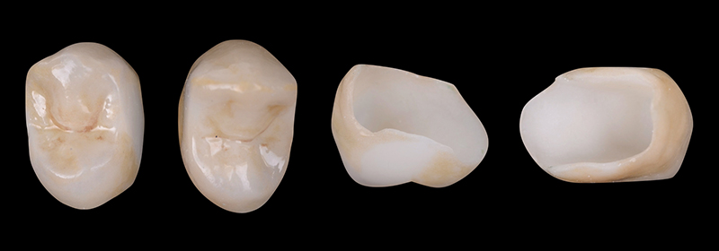 Les restaurations partielles en céramique sont élaborées en disilicate de lithium