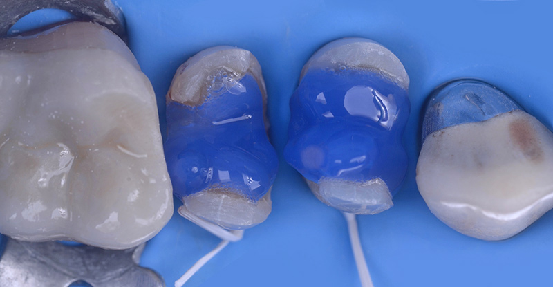 La surface dentinaire est mordancée et hybridée avec un adhésif MR3 épais