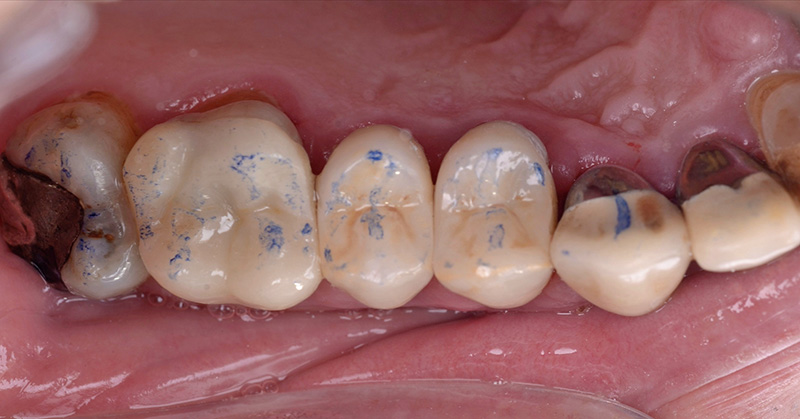 L’occlusion est réglée avec précision uniquement après le collage pour éviter tout risque de fracture de la céramique