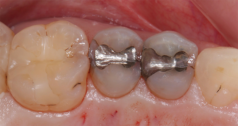 Protocole : lésions carieuses secondaires ont été détectées sur les deux dents