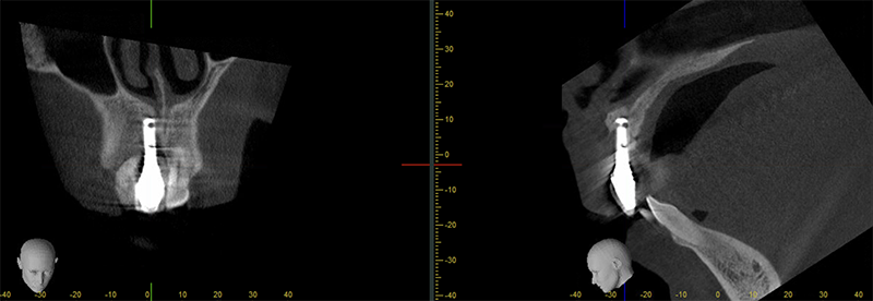 Prise en charge, Cone beam initial en coupe coronale et sagittale oblique centrée sur l’implant en site 11