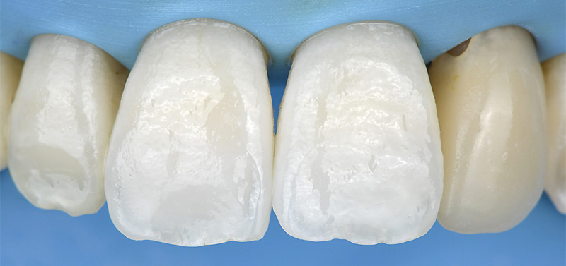 fluorose, Aspect des dents après l’étape d’infiltration