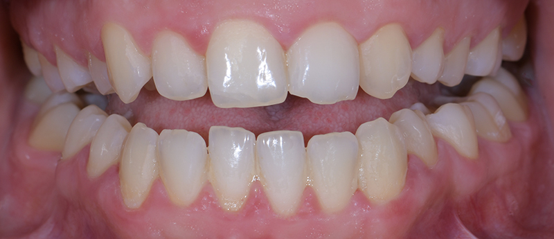 Ralph Boutros - Situation avant traitement orthodontique