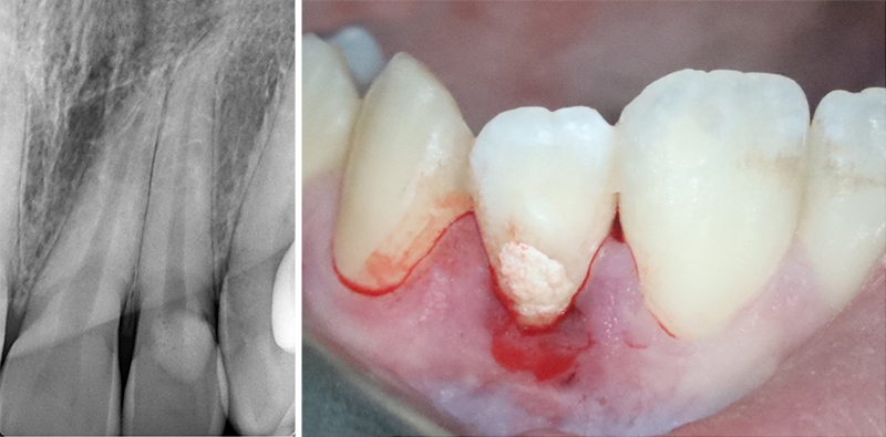 dent 22 - radiographie rétro alvéolaire et photo pré-opératoire