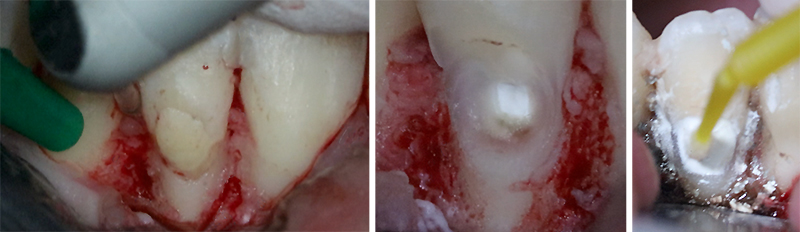 hoto per opératoires de la phase chirurgicale du traitement de la résorption externe cervicale