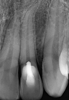 radiographie rétro alvéolaire post opératoire à + 6 mois