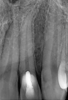 radiographie rétro alvéolaire post opératoire à + 12 mois