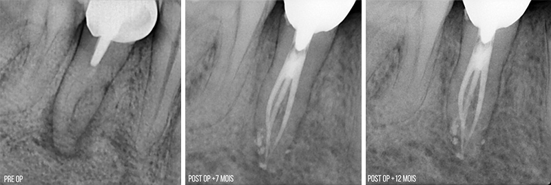 Dent 45 – radiographies pre et post opératoires à +7 mois et à + 12 mois post opératoire