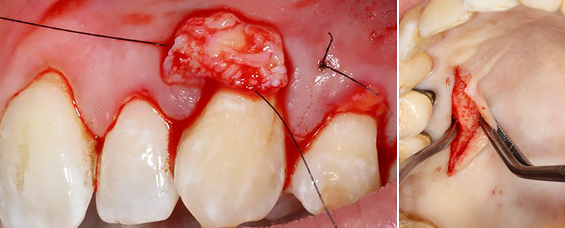 L’hygiène orale après une chirurgie muco-gingivale, greffe