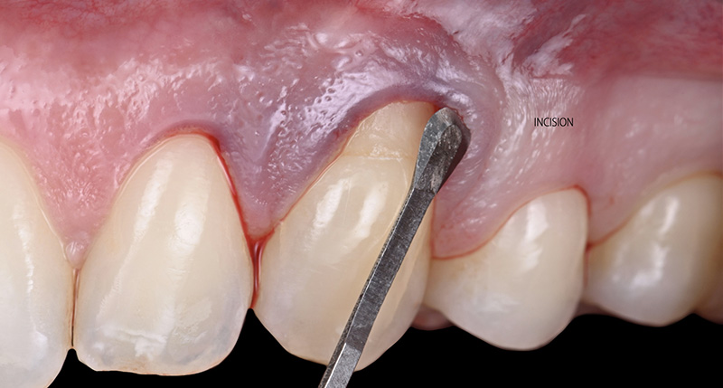 Incision intra-sulculaire à l’aide d’une lame Spoon Blade MJK®